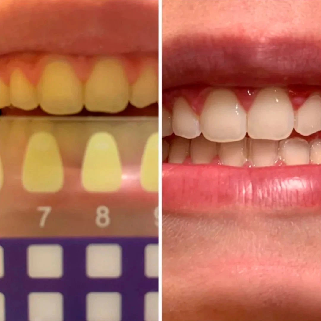 Kit Blanqueador Dental RebelSmile™ - Rebel